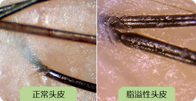 脱发原因之脂溢性脱发